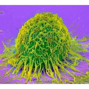 Cervical cancer cell, SEM Framed Prints